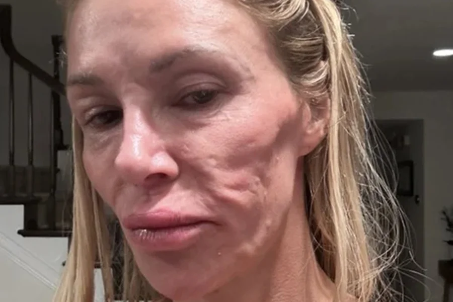 Influenciadora revela resultado de procedimento facial após doença rara