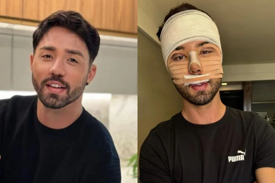 Rico Melquiades soma 15 cirurgias plásticas e afirma que seguirá com procedimentos